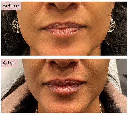 lip fillers before and afters